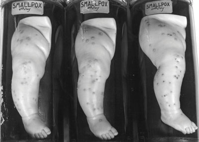 NottSmallpox ARCHIVES