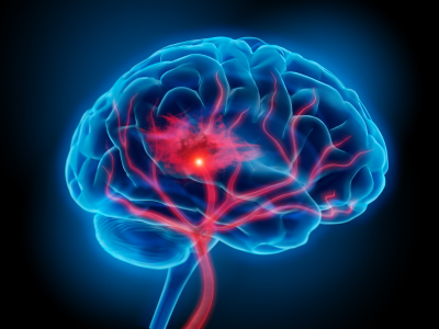 UAB joins study to slow bleeding in the brain