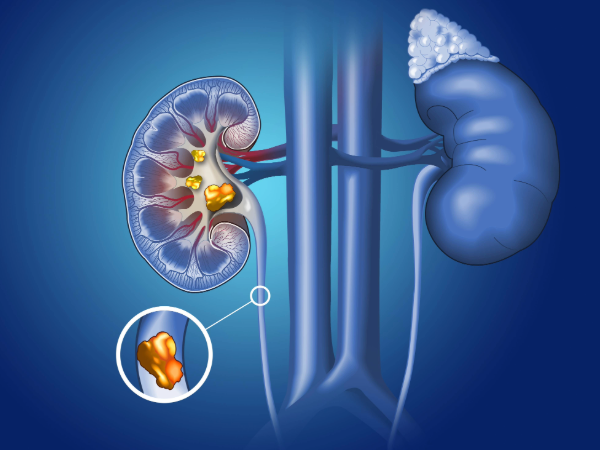 Medical illustration showing the kidneys and urinary tract highlighting kidney stones