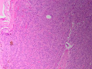 FA_bizarre_nuclei_10x.jpg