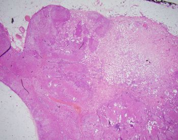 collsion tumor