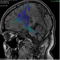 mri_left