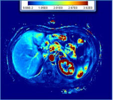 mri_right