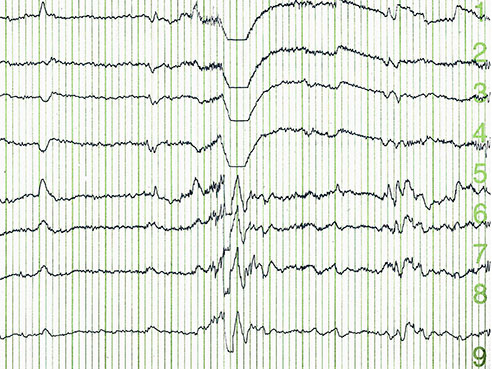 eeg