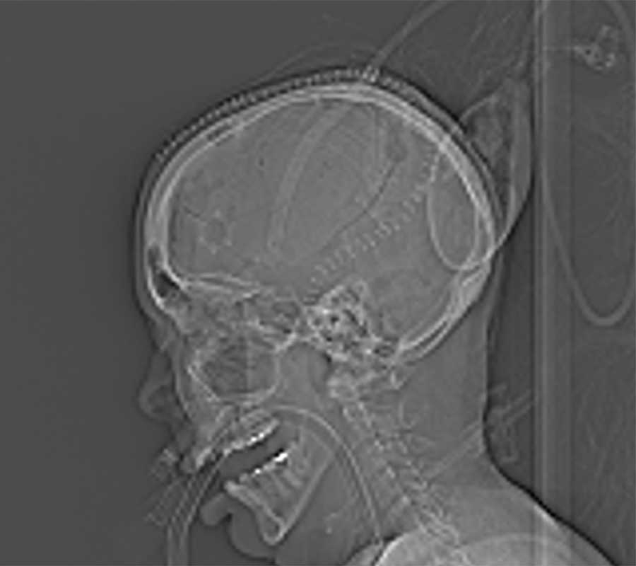 UAB employee recovers from TBI 04